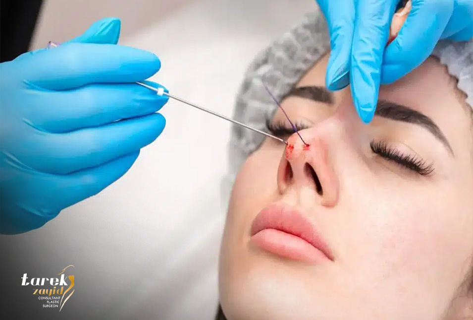 تجميل الأنف بالخيوط